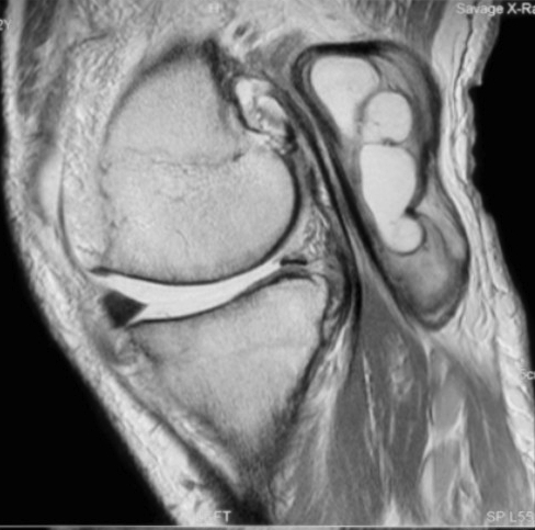 Baker's Cyst Knee Sagittal MRI